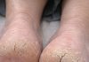 My heels are so dry they’re cracking and catching on socks. What causes this?