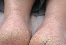 My heels are so dry they’re cracking and catching on socks. What causes this?