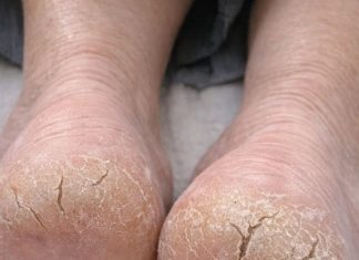 My heels are so dry they’re cracking and catching on socks. What causes this?