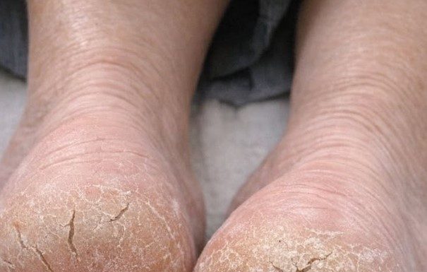 My heels are so dry they’re cracking and catching on socks. What causes this?