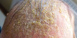 Oozing yellow crust on my scalp won’t heal. Clinic waitlist is long. What is it?