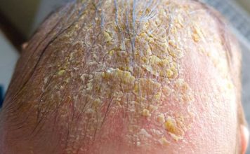 Oozing yellow crust on my scalp won’t heal. Clinic waitlist is long. What is it?