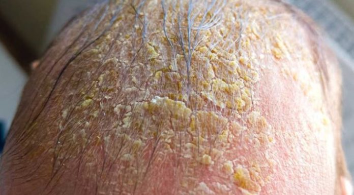 Oozing yellow crust on my scalp won’t heal. Clinic waitlist is long. What is it?