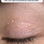 Tiny white bumps keep showing up on my eyelids, and I can’t get in to be seen yet. What are these?