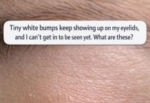 Tiny white bumps keep showing up on my eyelids, and I can’t get in to be seen yet. What are these?