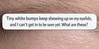 Tiny white bumps keep showing up on my eyelids, and I can’t get in to be seen yet. What are these?