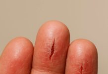 My fingertips keep splitting open in the cold, but I can’t get in to see the doctor anytime soon. What can I do now?