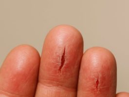 My fingertips keep splitting open in the cold, but I can’t get in to see the doctor anytime soon. What can I do now?