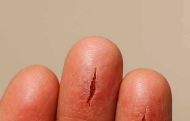 My fingertips keep splitting open in the cold, but I can’t get in to see the doctor anytime soon. What can I do now?