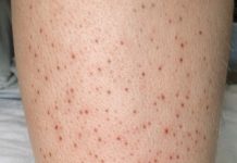 Small red dots keep spreading on my lower legs, and I can’t get checked yet. What can I do now?