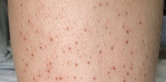 Small red dots keep spreading on my lower legs, and I can’t get checked yet. What can I do now?