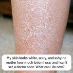 My skin looks white, scaly, and ashy no matter how much lotion I use, and I can’t see a doctor soon. What can I do now?