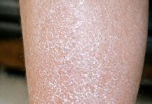 My skin looks white, scaly, and ashy no matter how much lotion I use, and I can’t see a doctor soon. What can I do now?