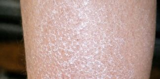 My skin looks white, scaly, and ashy no matter how much lotion I use, and I can’t see a doctor soon. What can I do now?