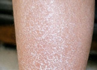 My skin looks white, scaly, and ashy no matter how much lotion I use, and I can’t see a doctor soon. What can I do now?