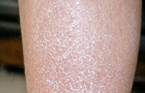 My skin looks white, scaly, and ashy no matter how much lotion I use, and I can’t see a doctor soon. What can I do now?