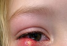 Sudden Painful Eyelid Lump in Teens: Causes, Care, and When to Seek Help