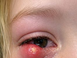 Sudden Painful Eyelid Lump in Teens: Causes, Care, and When to Seek Help