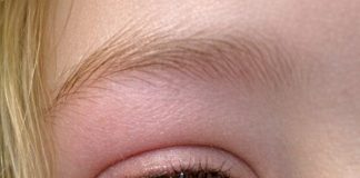 Sudden Painful Eyelid Lump in Teens: Causes, Care, and When to Seek Help