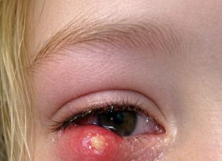 Sudden Painful Eyelid Lump in Teens: Causes, Care, and When to Seek Help