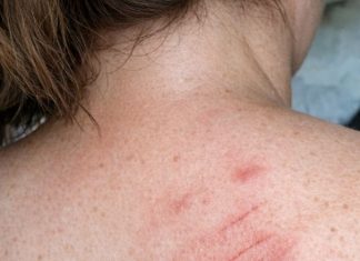 One spot on my back itches constantly and won’t stop, and I can’t see a doctor soon. What can I do now?