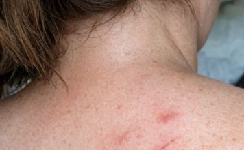 One spot on my back itches constantly and won’t stop, and I can’t see a doctor soon. What can I do now?