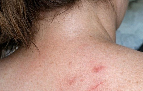 One spot on my back itches constantly and won’t stop, and I can’t see a doctor soon. What can I do now?