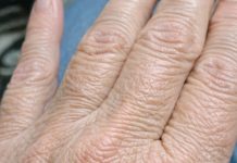 My hands suddenly look thin and crepey in winter, and lotion barely helps. What can I do right now?