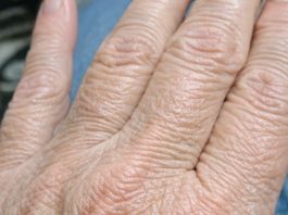 My hands suddenly look thin and crepey in winter, and lotion barely helps. What can I do right now?