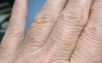 My hands suddenly look thin and crepey in winter, and lotion barely helps. What can I do right now?