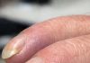 Why Are My Dad’s Fingertips Becoming Rounded and His Nails Curving Over the Edge?