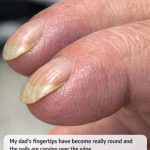 Why Are My Dad’s Fingertips Becoming Rounded and His Nails Curving Over the Edge?