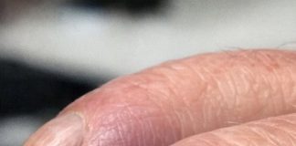 Why Are My Dad’s Fingertips Becoming Rounded and His Nails Curving Over the Edge?