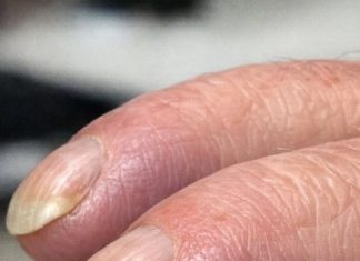 Why Are My Dad’s Fingertips Becoming Rounded and His Nails Curving Over the Edge?