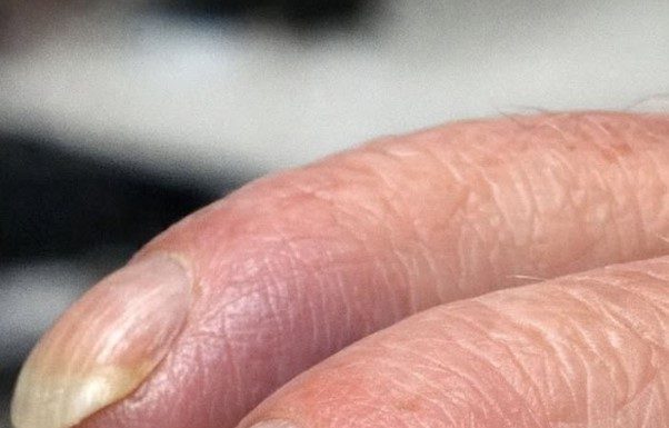 Why Are My Dad’s Fingertips Becoming Rounded and His Nails Curving Over the Edge?