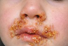 My toddler just developed these crusty sores around his mouth overnight. Pediatrician is booked for weeks. What can I put on this?