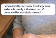 My grandmother developed this strange lump on her wrist overnight. What could this be? I am worried because it looks abnormal.