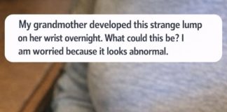 My grandmother developed this strange lump on her wrist overnight. What could this be? I am worried because it looks abnormal.