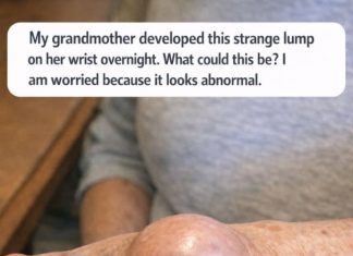 My grandmother developed this strange lump on her wrist overnight. What could this be? I am worried because it looks abnormal.