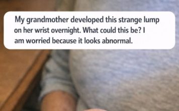 My grandmother developed this strange lump on her wrist overnight. What could this be? I am worried because it looks abnormal.