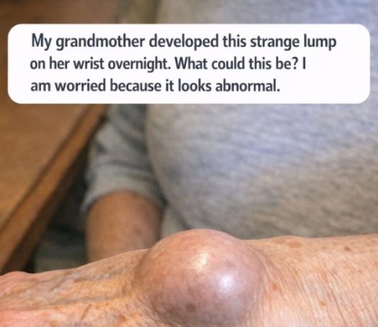 My grandmother developed this strange lump on her wrist overnight. What could this be? I am worried because it looks abnormal.