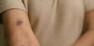 These sudden purple patches on my arms won’t stop appearing, and my doctor is booked until January. What’s happening?