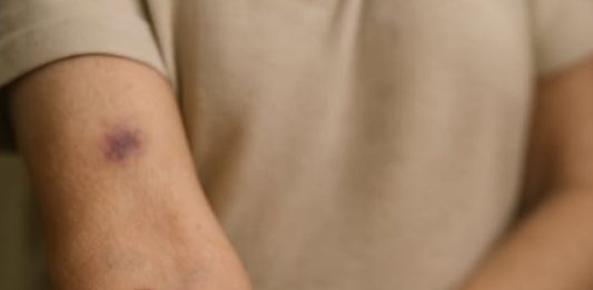 These sudden purple patches on my arms won’t stop appearing, and my doctor is booked until January. What’s happening?