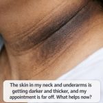 The skin in my neck and underarms is getting darker and thicker, and my appointment is far off. What helps now?
