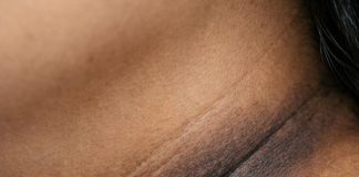 The skin in my neck and underarms is getting darker and thicker, and my appointment is far off. What helps now?