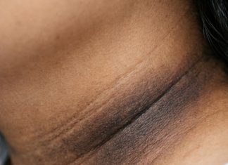 The skin in my neck and underarms is getting darker and thicker, and my appointment is far off. What helps now?