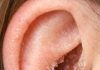 The skin inside my ears keeps drying out and flaking in February. What causes this?