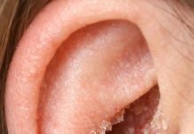 The skin inside my ears keeps drying out and flaking in February. What causes this?