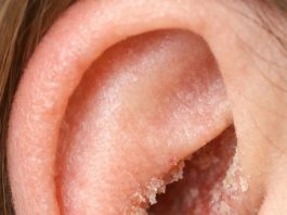 The skin inside my ears keeps drying out and flaking in February. What causes this?