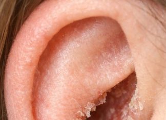 The skin inside my ears keeps drying out and flaking in February. What causes this?